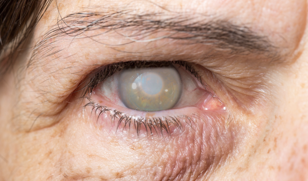 ojo de adulto mayor que evidencia presencia de glaucoma